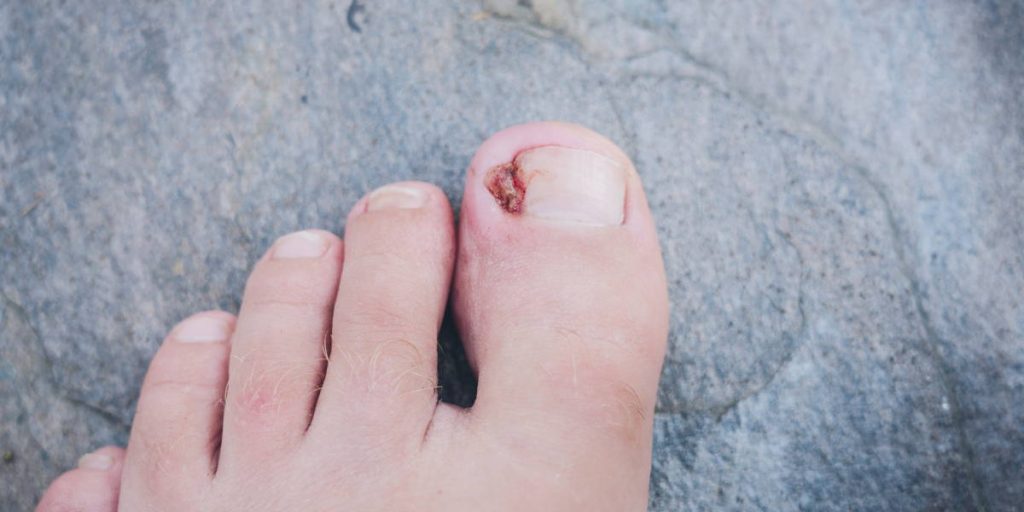 Ingrown Toenail Excision Qidwai Clinic Sydney