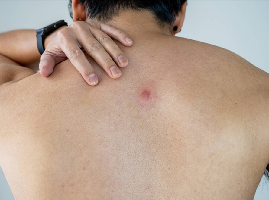 Man with Skin Abscess on his back getting an Excision & treatment at Qidwai Clinic in Sydney